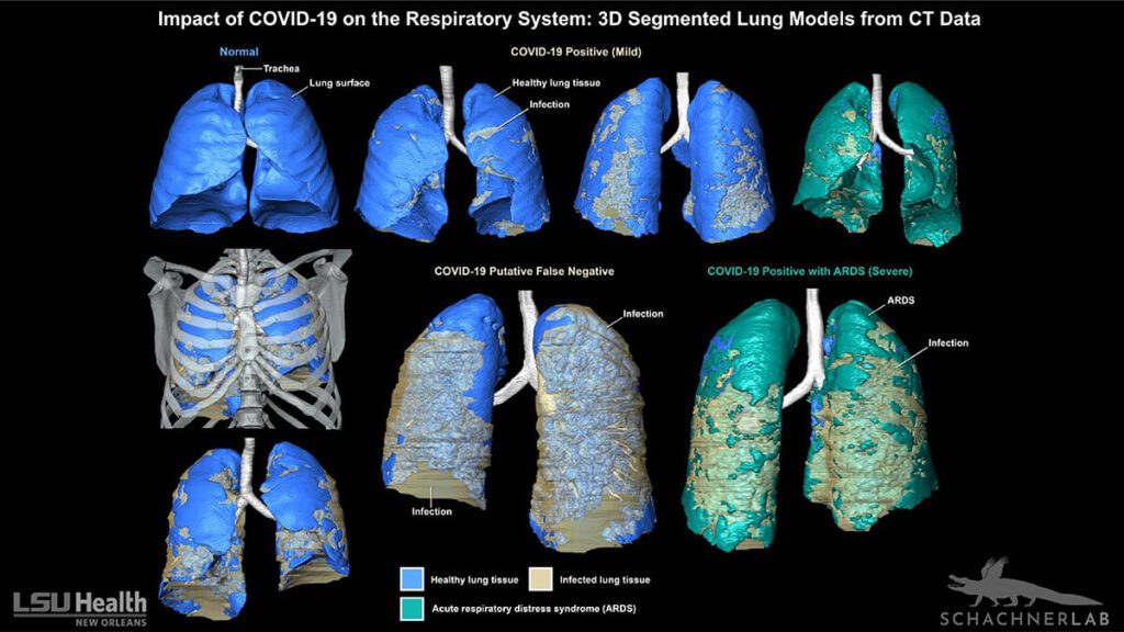 Accurate 3D imaging for Covid-19 diagnosis
