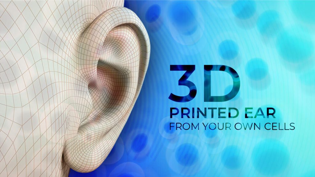 3D-Printed Ear Implant