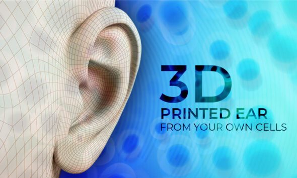 3D-Printed Ear Implant
