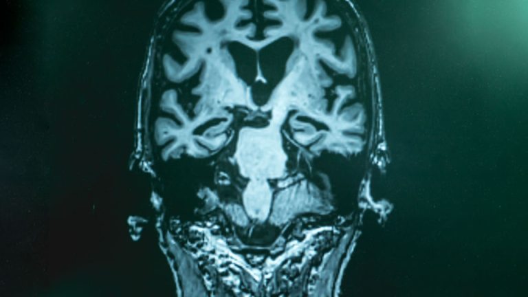 early Alzheimer's detection