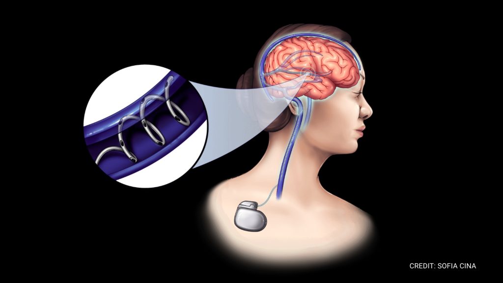 Neurobionics, an MIT spinout, is leading neuromodulation technology to treat neurological disorders like Parkinson, epilepsy, and depression.