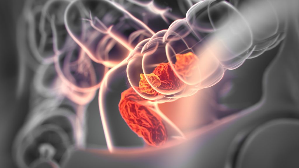AI detects tumor quicker than human AI tumor detection AI detecting tumors AI in computational pathology identify tumor in cells medical imaging computational pathology analysis and AI driven